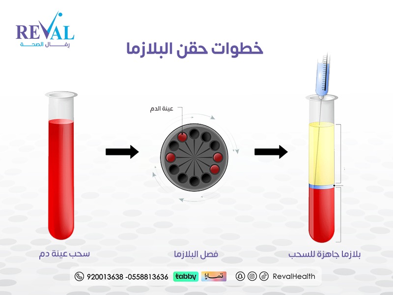 ما هي طريقة حقن بلازما الوجه؟