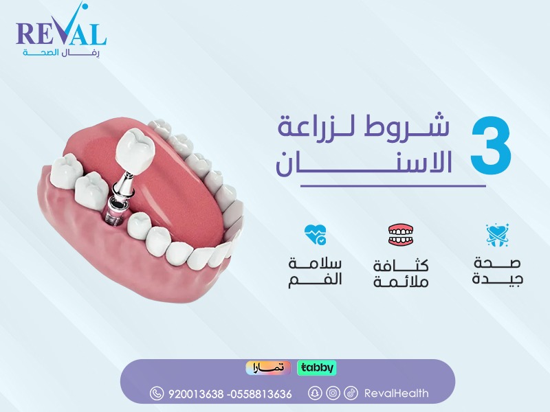 أنواع زراعة الأسنان وأسعارها في الرياض\ تعرف على أفضل العروض والخصومات