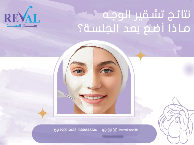 نتائج تشقير الوجه: اسرار تجربتي مع تشقير شعر الوجه بالليزر