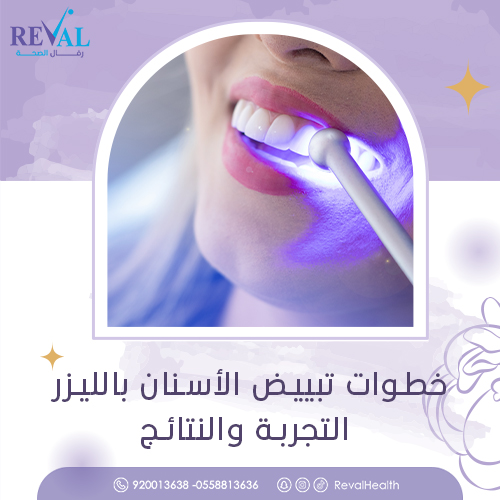 تعليمات قبل وبعد تبييض الاسنان