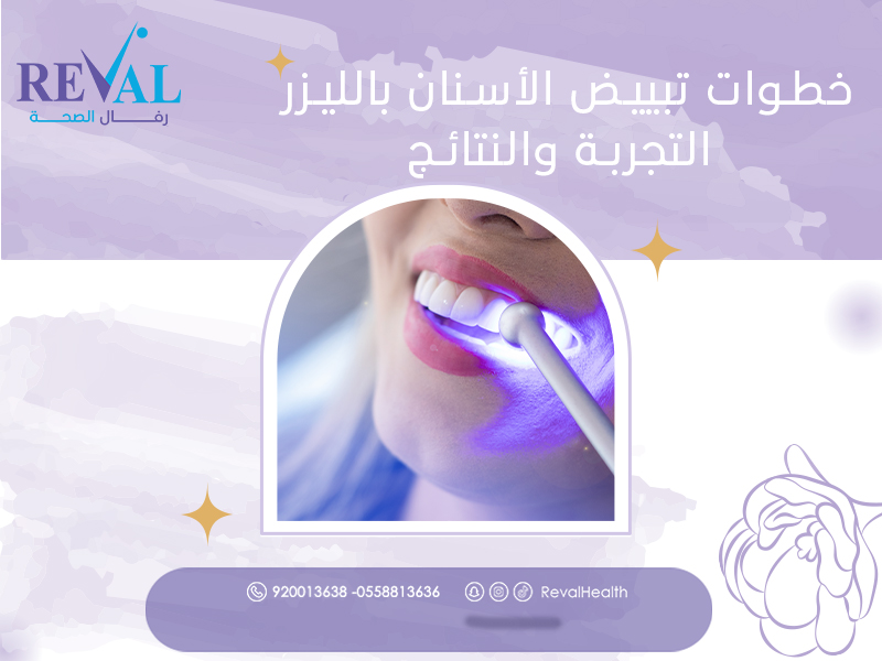 خطوات تبييض الأسنان
