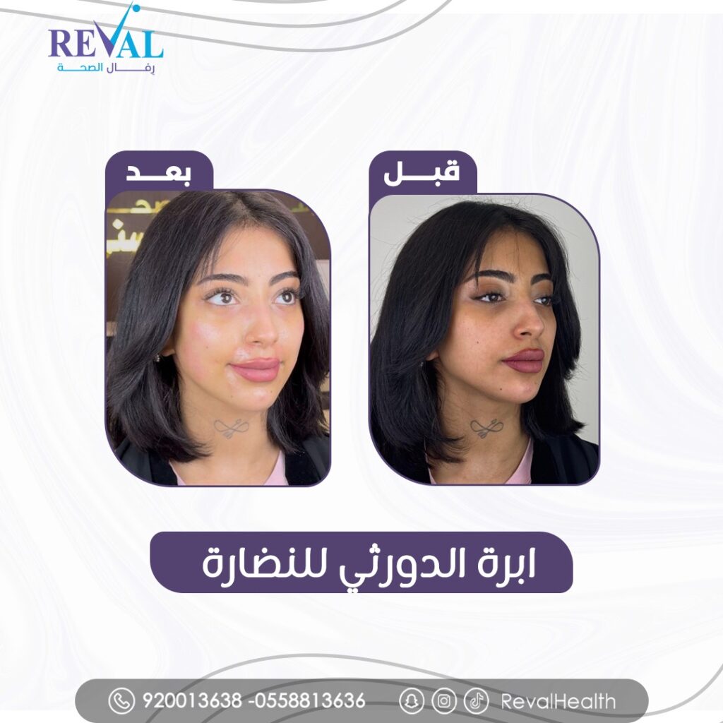 ابرة الدورثي قبل وبعد