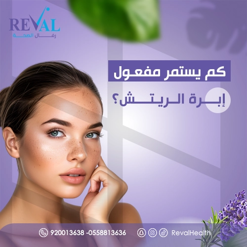 كم يدوم مفعول إبرة الريتش