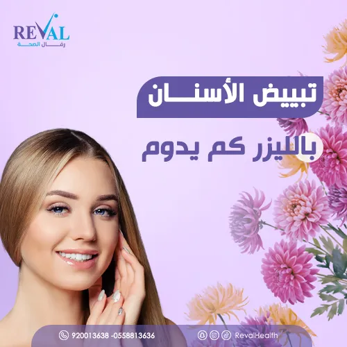 تبييض الأسنان بالليزر كم يدوم: ونصائح ليدوم طويلاً