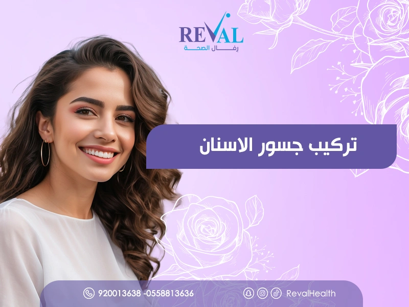 تركيب جسور الأسنان: نصائح قبل وبعد جلسات تركيبات الاسنان
