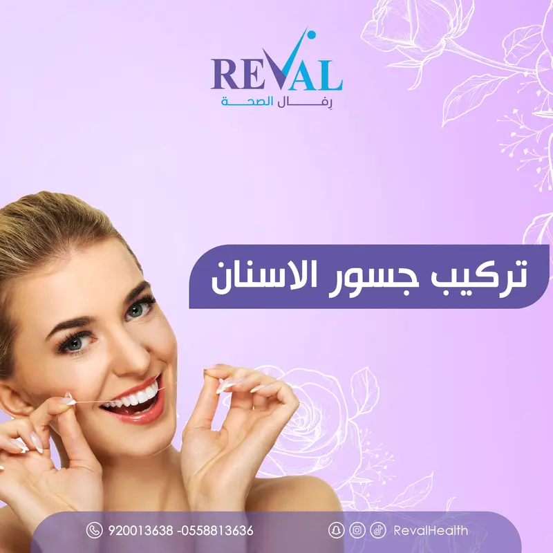 تركيب جسور الأسنان: نصائح قبل وبعد جلسات تركيبات الاسنان