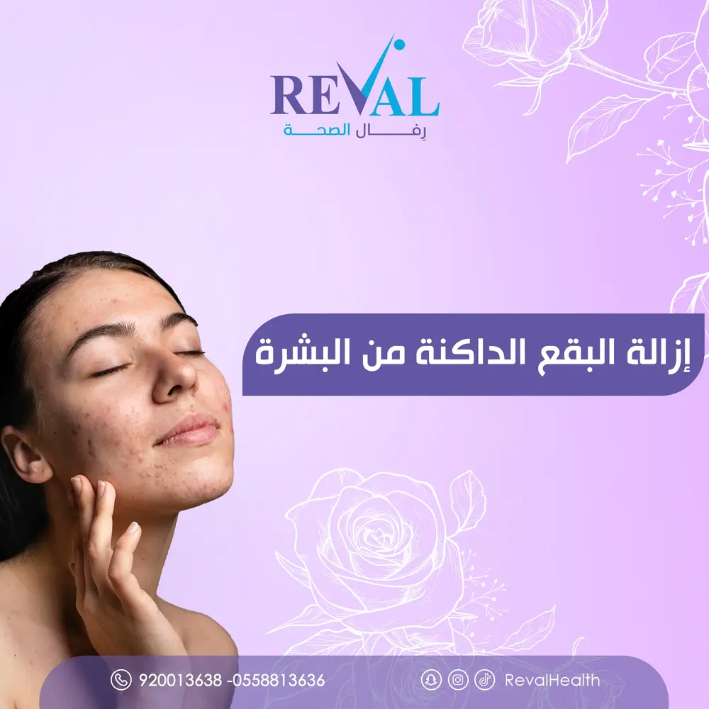 تجربتي مع إزالة البقع الداكنة من البشرة