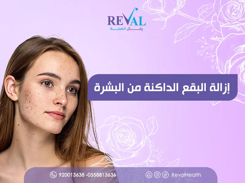 إزالة البقع الداكنة من البشرة