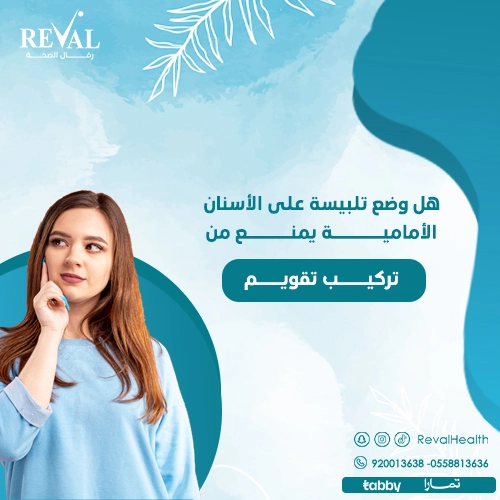  تركيب التقويم مع وجود تلبيسات الأسنان
