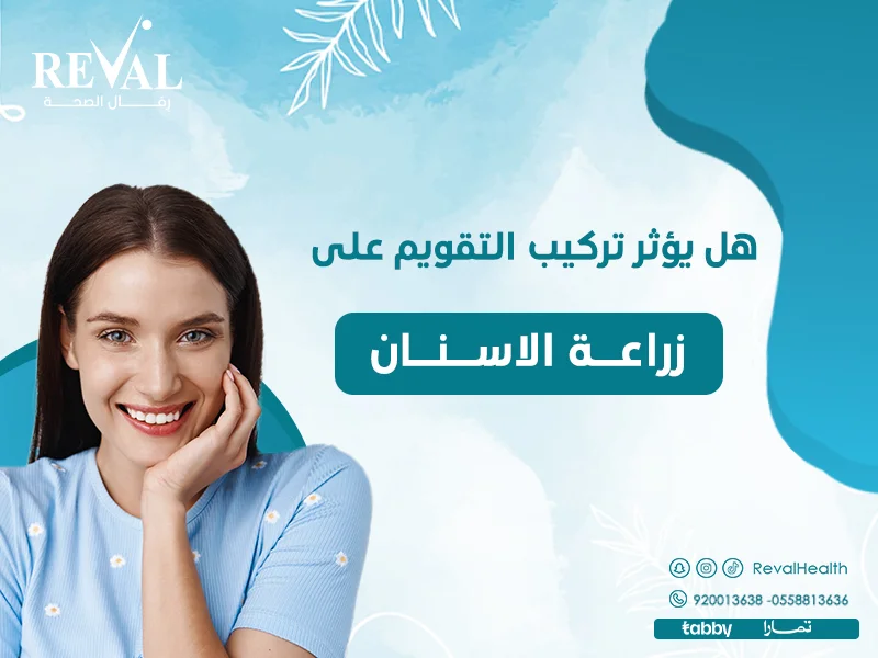 هل يؤثر تركيب التقويم على زراعة الأسنان؟ وهل يمكن تركيب التقويم بعد زراعة الأسنان؟