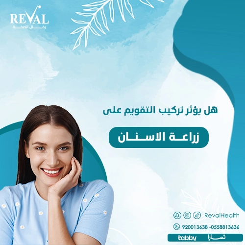 هل يصلح تركيب التقويم على التلبيسة؟