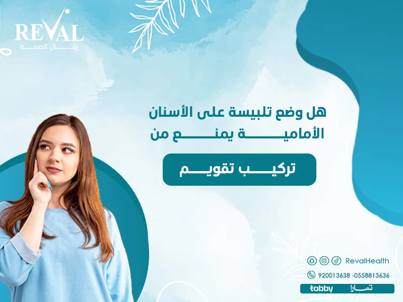 هل وضع تلبيسة على الأسنان الأمامية يمنع من تركيب تقويم ⁉️