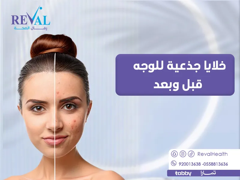 خلايا جذعية للوجه قبل وبعد: اسرار تجربتي مع جلسات حقن الخلايا الجذعية