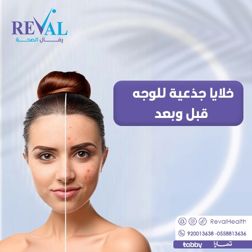 تجربتي مع الخلايا الجذعية للوجه
