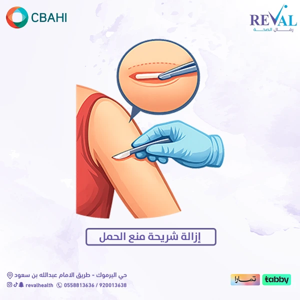 كيف تتم عملية إزالة شريحة منع الحمل خطوة بخطوة