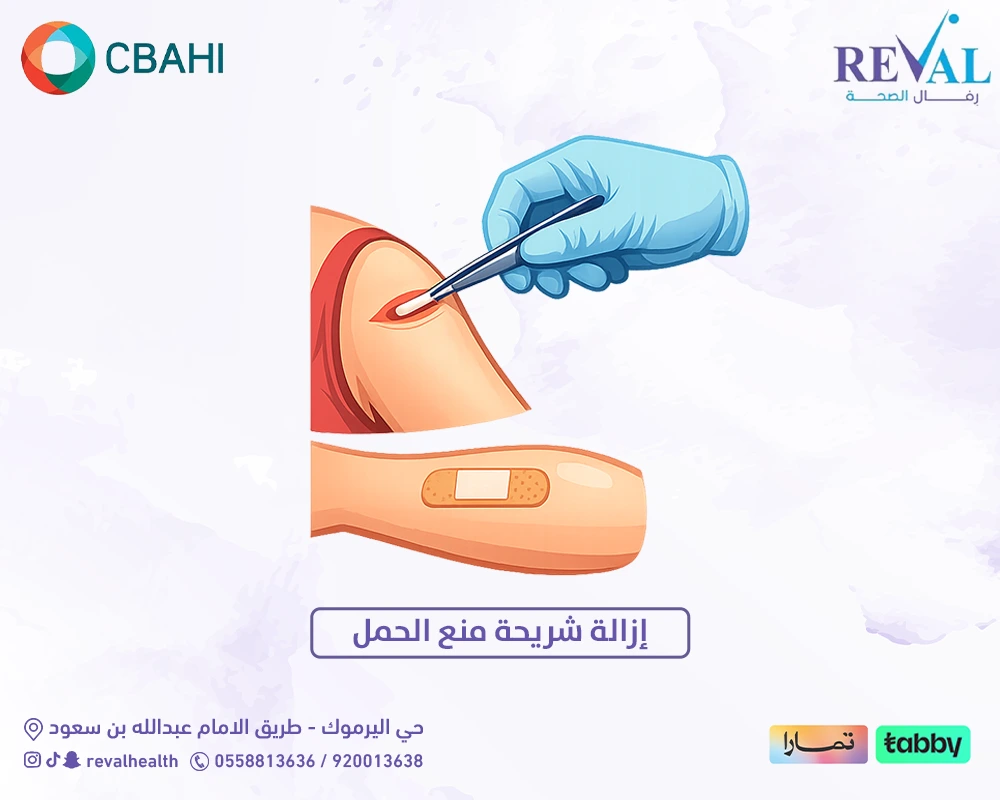 إزالة شريحة منع الحمل