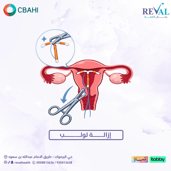 تجربتي مع إزالة لولب
