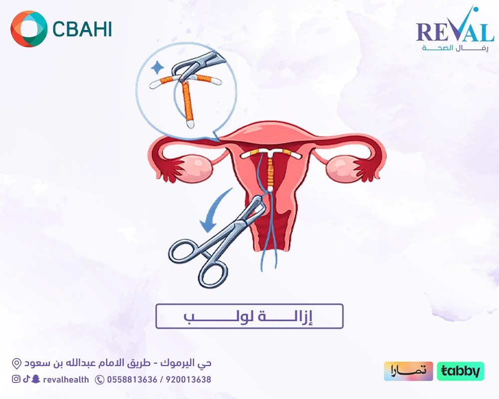 إزالة لولب