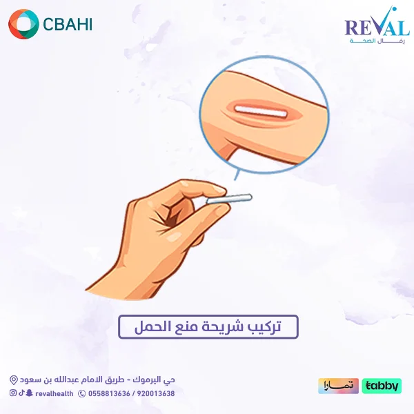 ما هي شريحة منع الحمل وكيف تعمل داخل الجسم؟