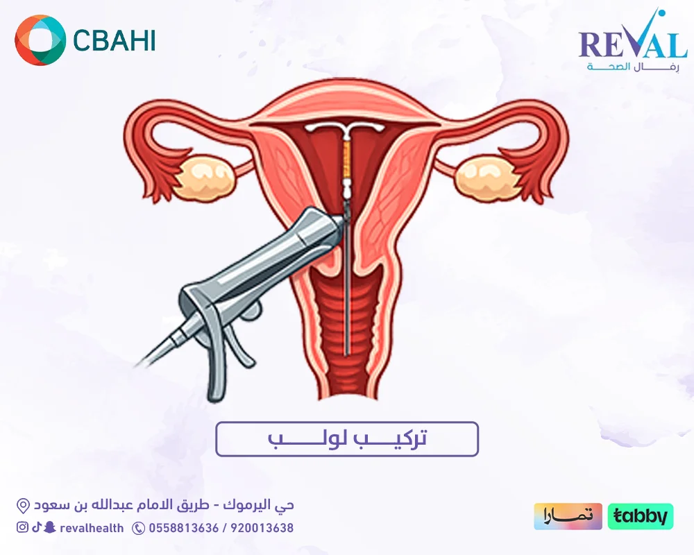 تركيب لولب: الدليل الشامل خطوة بخطوة لكل ما تحتاجين معرفته قبل التركيب وبعده