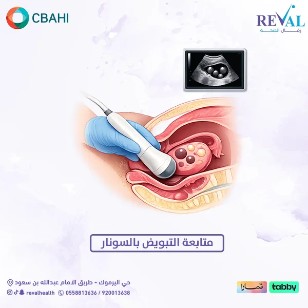 تجربتي مع متابعة التبويض بالسونار
