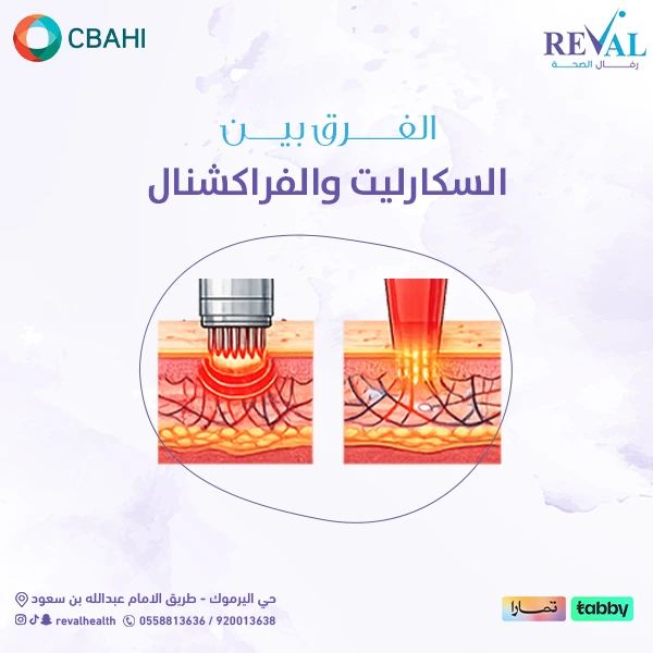 السكارليت والفراكشنال