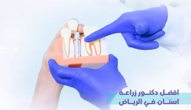 افضل دكتور زراعة اسنان في الرياض: أسرار اختيار الطبيب والعيادة المناسبة بنجاح
