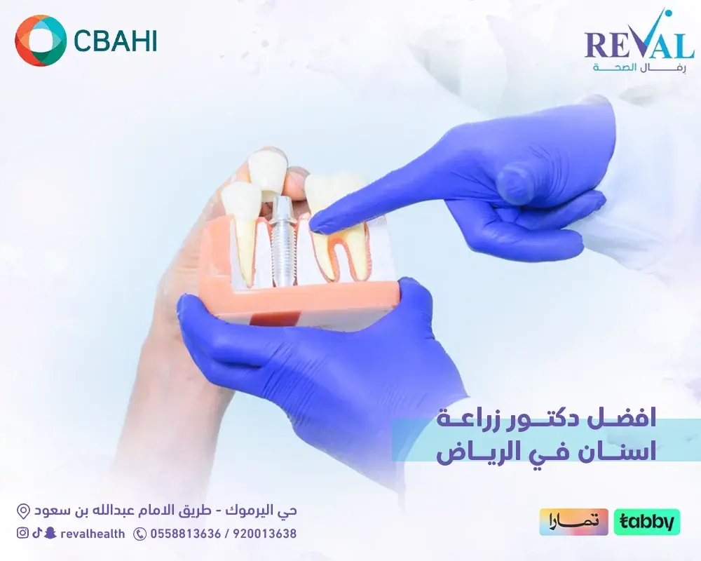 افضل دكتور زراعة اسنان في الرياض: أسرار اختيار الطبيب والعيادة المناسبة بنجاح