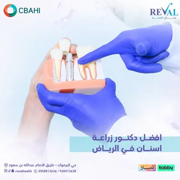 نصائح قبل الخضوع لعملية زراعة الأسنان