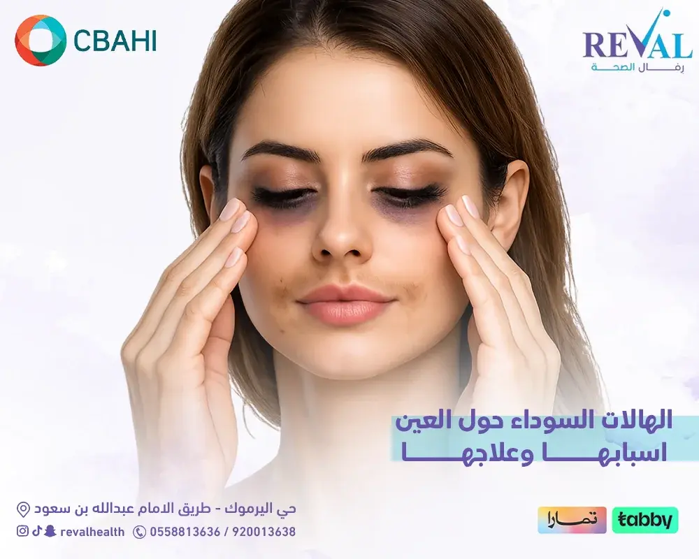 الهالات السوداء حول العين اسبابها وعلاجها: أسرار التخلص منها نهائياً
