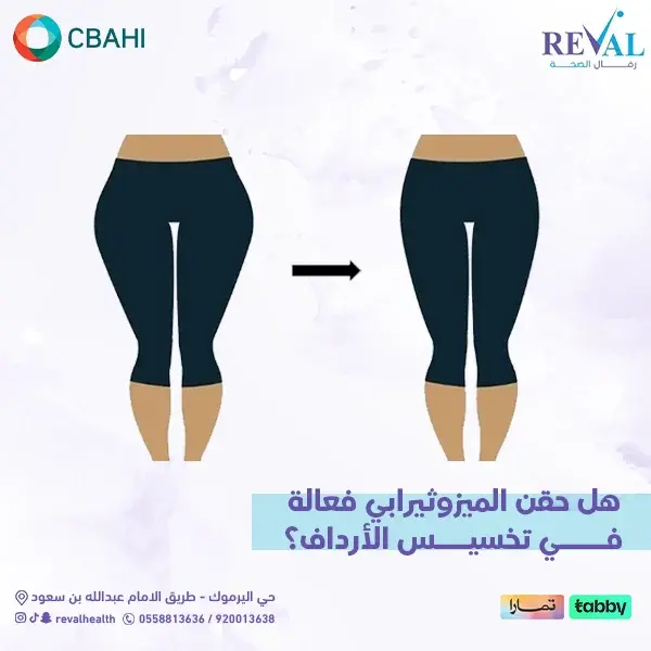 تجربتي مع حقن الميزوثيرابي لتخسيس الأرداف