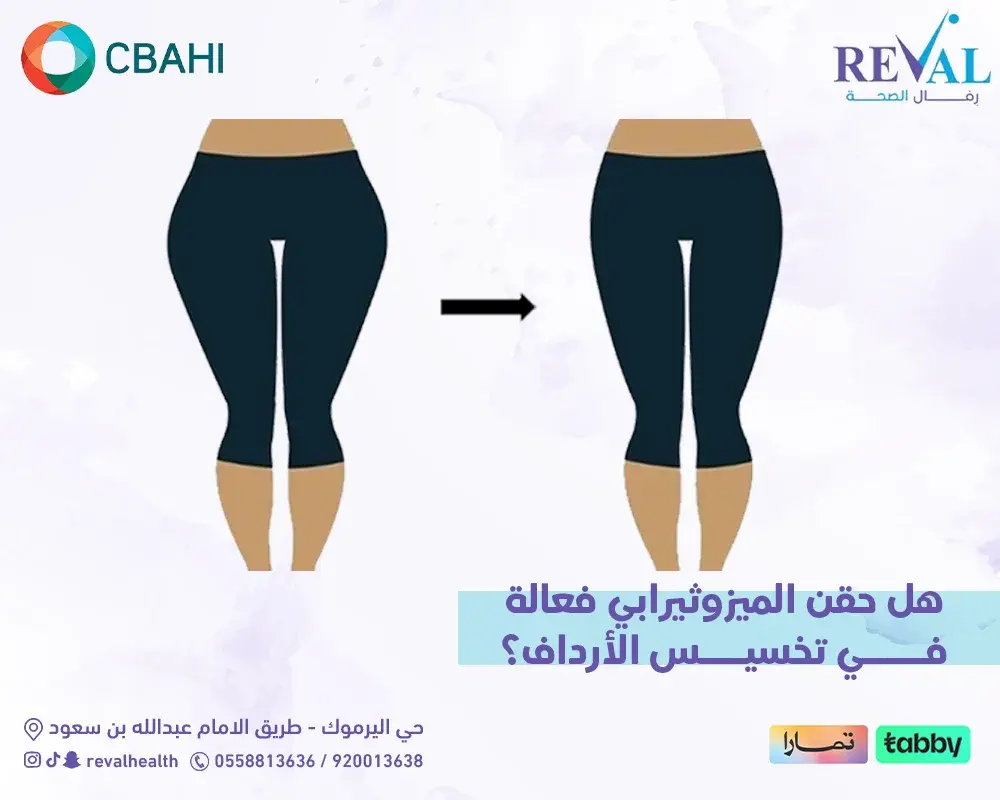 هل حقن الميزوثيرابي فعالة في تخسيس الأرداف؟ النتائج والفوائد وعدد الجلسات