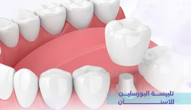 تلبيسة البورسلين للأسنان: الدليل الشامل لاستعادة جمال ووظيفة الابتسامة