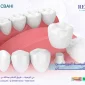تلبيسة البورسلين للاسنان 1 85x85
