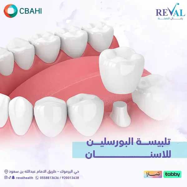 نصائح قبل تركيب تلبيسة البورسلين للأسنان