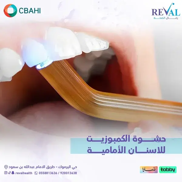 نصائح للحفاظ على حشوة الكمبوزيت لفترة أطول