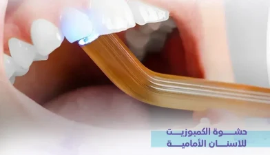 حشوة الكمبوزيت للأسنان الأمامية: الدليل الشامل لاختيار ابتسامة طبيعية ومثالية