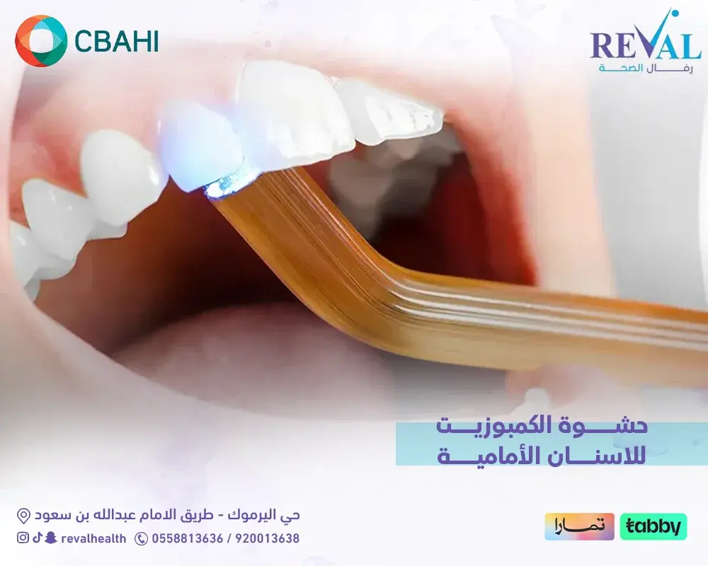 حشوة الكمبوزيت للأسنان الأمامية: الدليل الشامل لاختيار ابتسامة طبيعية ومثالية