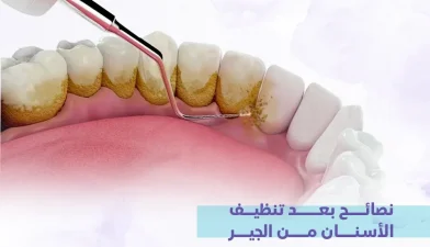 نصائح بعد تنظيف الأسنان من الجير