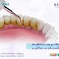 نصائح بعد تنظيف الأسنان من الجير 1 85x85