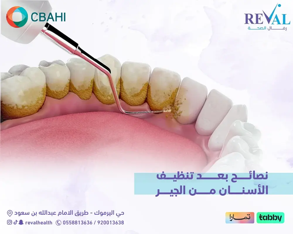 نصائح بعد تنظيف الأسنان من الجير