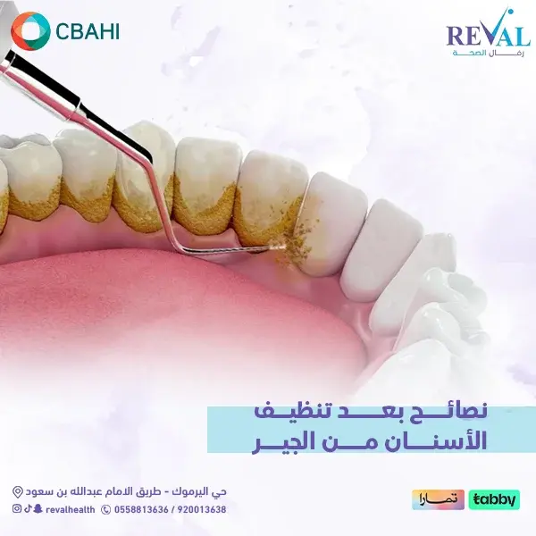 متى تظهر نتائج تنظيف الأسنان من الجير؟